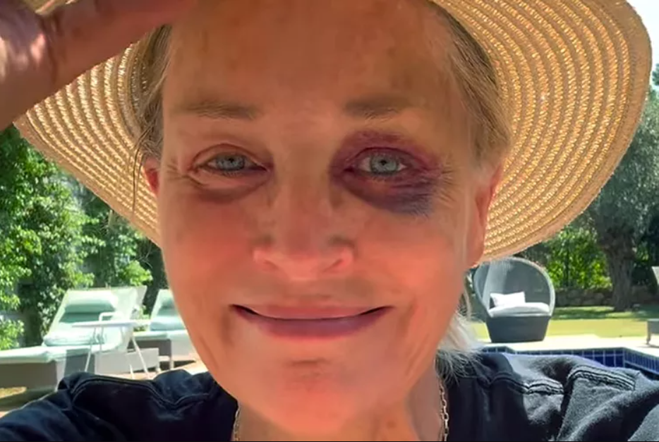 H Sharon Stone εμφανίστηκε με μαυρισμένο μάτι και τρόμαξε τους πάντες – Τι ακριβώς της συνέβη 2